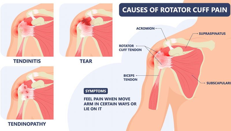 Rotator Cuff Strain Injuries - Mississauga and Oakville