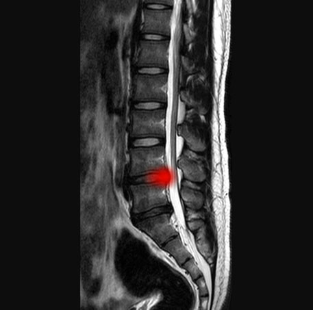 What Is Degenerative Disc Disease? - Orthopedic & Sports Medicine