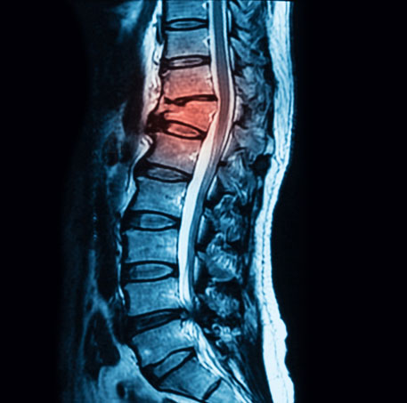 Compression fractures of the back Information